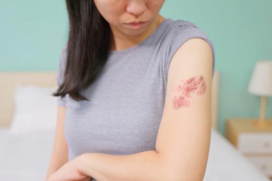 Woman with shingles on her upper arm